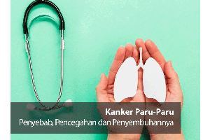Kanker Paru-paru: Penyebab, Pencegahan dan Penyembuhan_
